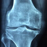 X-Ray Image of a Joint